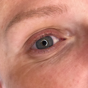 3. Міжвійка До процедури