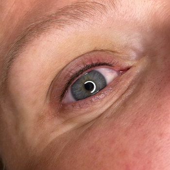 3. Після процедури