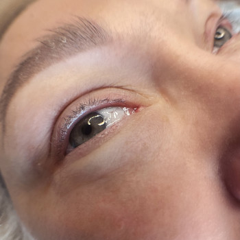 4. Міжвійка До процедури