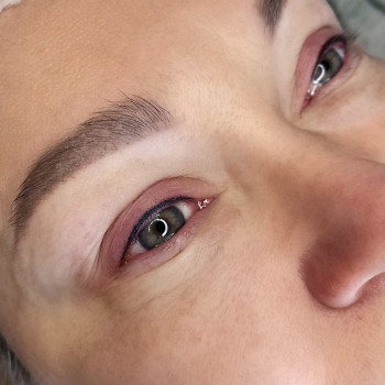 4. Після процедури