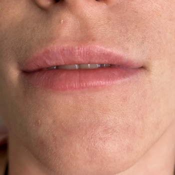 Аугментація губ
                    Косметолог Татьяна Київ