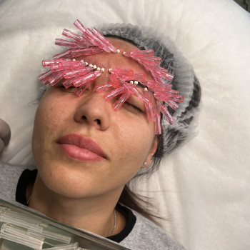 Омолодження # шкіри в зоні лоба та міжбрівки #