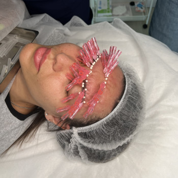 Омолодження нитками #