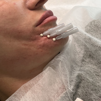 нижня третина ниточки #