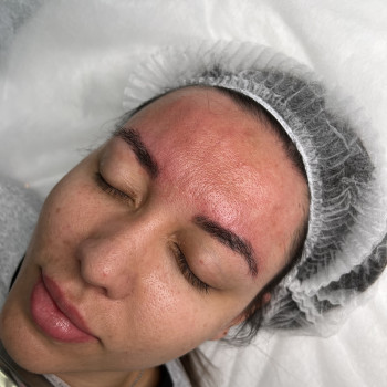 Тредліфтинг мезонитки
                    Косметолог-ін'єкціоніст Наталья Дніпро