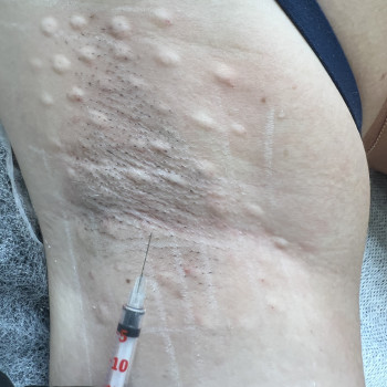 Лічение гипергидроза подмышет и лодоней
                    Косметолог-инъекционист Наталья Днепр