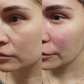 Контурна пластика
                    Лікар-косметолог Оксана Київ