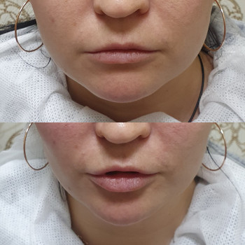 Контурна пластика
                    Лікар-косметолог Оксана Київ