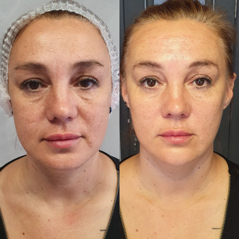 Контурна пластика
                    Лікар-косметолог Оксана Київ