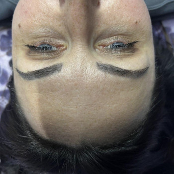 Процедура диодным лазером
                    Косметолог Инна Одесса