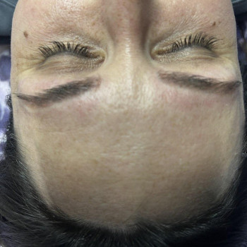 Процедура диодным лазером
                    Косметолог Инна Одесса