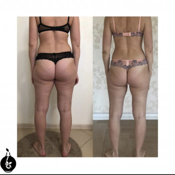 LPG масаж тіла
                    Косметологический центр  Киев