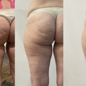 LPG масаж тіла
                    Косметологический центр  Киев