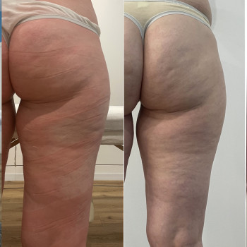 LPG масаж тіла
                    Косметологический центр  Киев