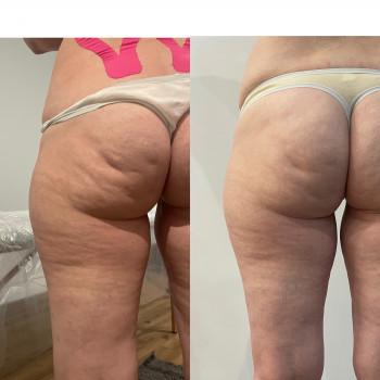 LPG масаж тіла
                    Косметологический центр  Киев