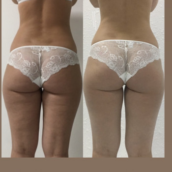 LPG масаж тіла
                    Косметологический центр  Киев