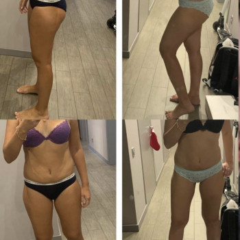 3 процедури + 5 LPG масажів