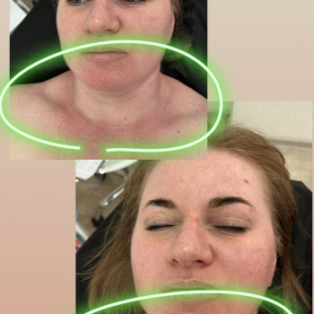 Масаж обличчя 30 хв
                    Масажист Дарья Київ