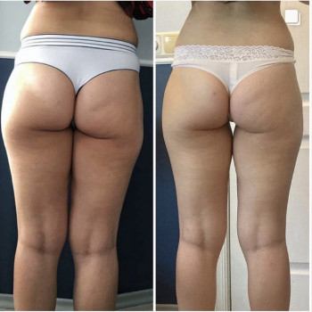 Антицелюлітний масаж
                    Масажний салон Massage Studio Київ