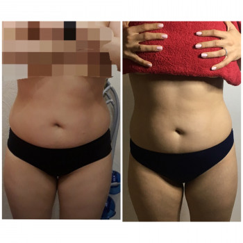 Антицелюлітний масаж
                    Масажний салон Massage Studio Київ