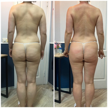 Антицелюлітний масаж
                    Масажний салон Massage Studio Київ