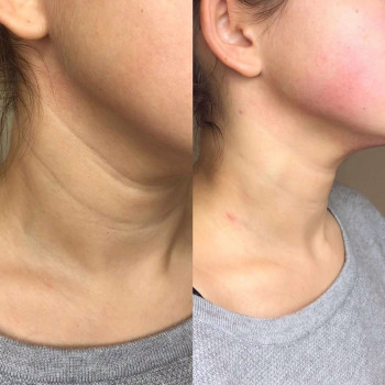 догляд за обличчям, корекціяз моршок