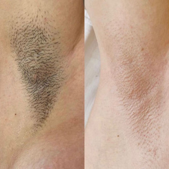 депіляція, лазерна епіляція