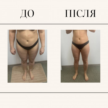 Вакуумно-роликовий масаж
                    Масажний салон  Київ