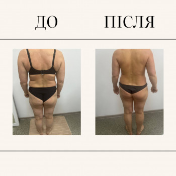 Вакуумно-роликовий масаж
                    Масажний салон  Київ