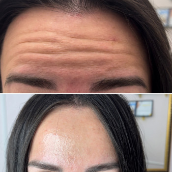 Ботокс горизонтальних ліній чола