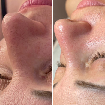 Комбінована чистка обличчя