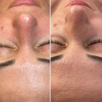 Комбінована чистка обличчя