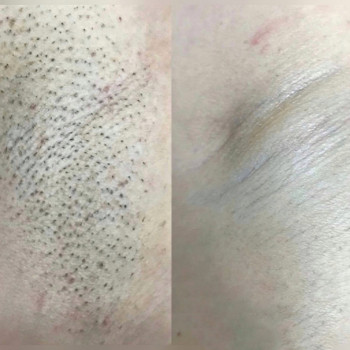 Лазерна епіляція Олександрія
                    Салон красоты LASH&BEAUTY STUDIO Александрия