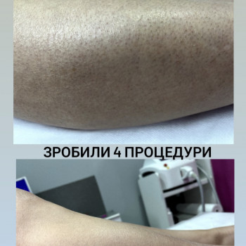 Лазерна епіляція Олександрія
                    Салон красоты LASH&BEAUTY STUDIO Александрия