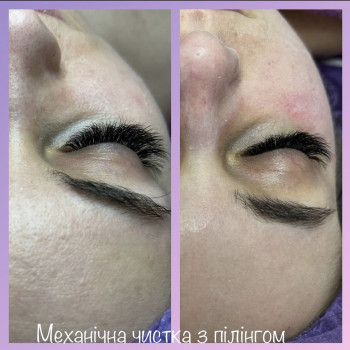 Механічна чистка з відновлюючим пілінгом