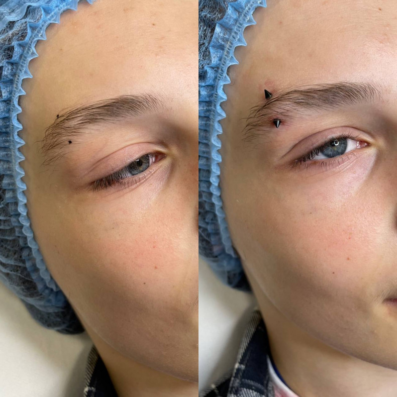 Пірсинг брови, фото - Лікар-косметолог Неля Костянтинівна Яременко