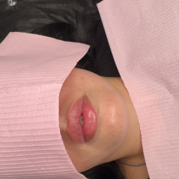 Контурна пластика губ. Відразу після процедури.