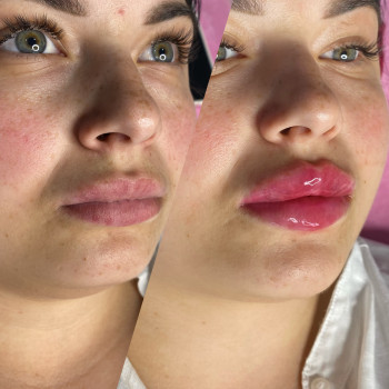 Губи до/після 
Контурна пластика 1 мл