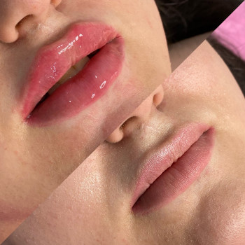 Губи після минулого майстра розчиняли та заповнювали 1мл