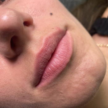 Губи до процедури