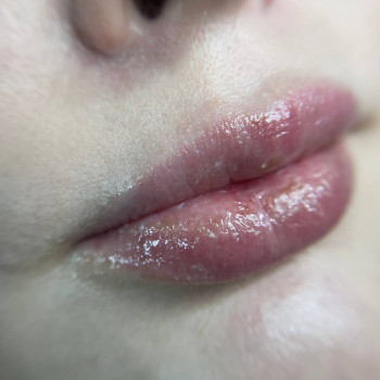 Губи до процедури