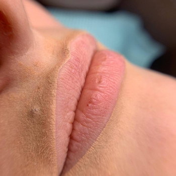 Губи до процедури