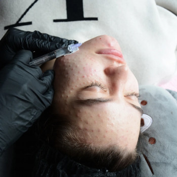 Біоревіталізація та біорепарація обличчя, шиї, декольте