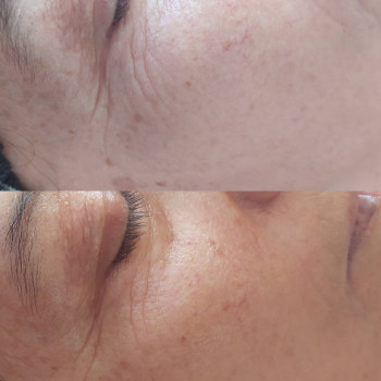 1 процедура "Миттєва краса" (Пацієнт 69 р.)