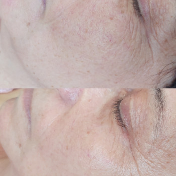 Уход "Миттєва краса"
                    Косметолог-эстетист Марина Одесса