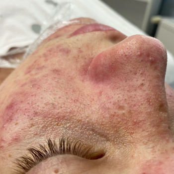 Чистка обличчя 
До