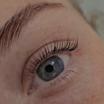 Після процедури