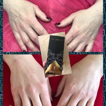 Відновлення обʼєму за допомогою гідроксіапатиту кальцію і гк