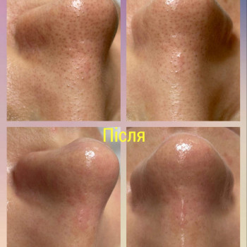 Комбінована чистка обличчя з пілінгом