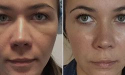 Карбоксітерапія Медицинский центр ДОКАРТ Харьков